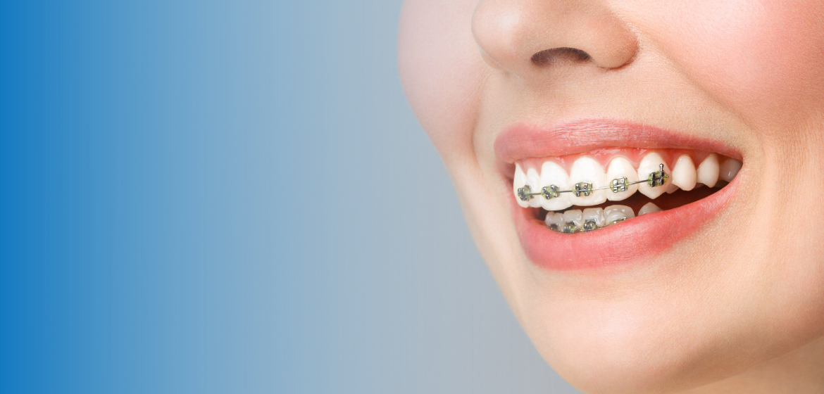 Ortodoncija – mobilni, fiksni aparati i folije