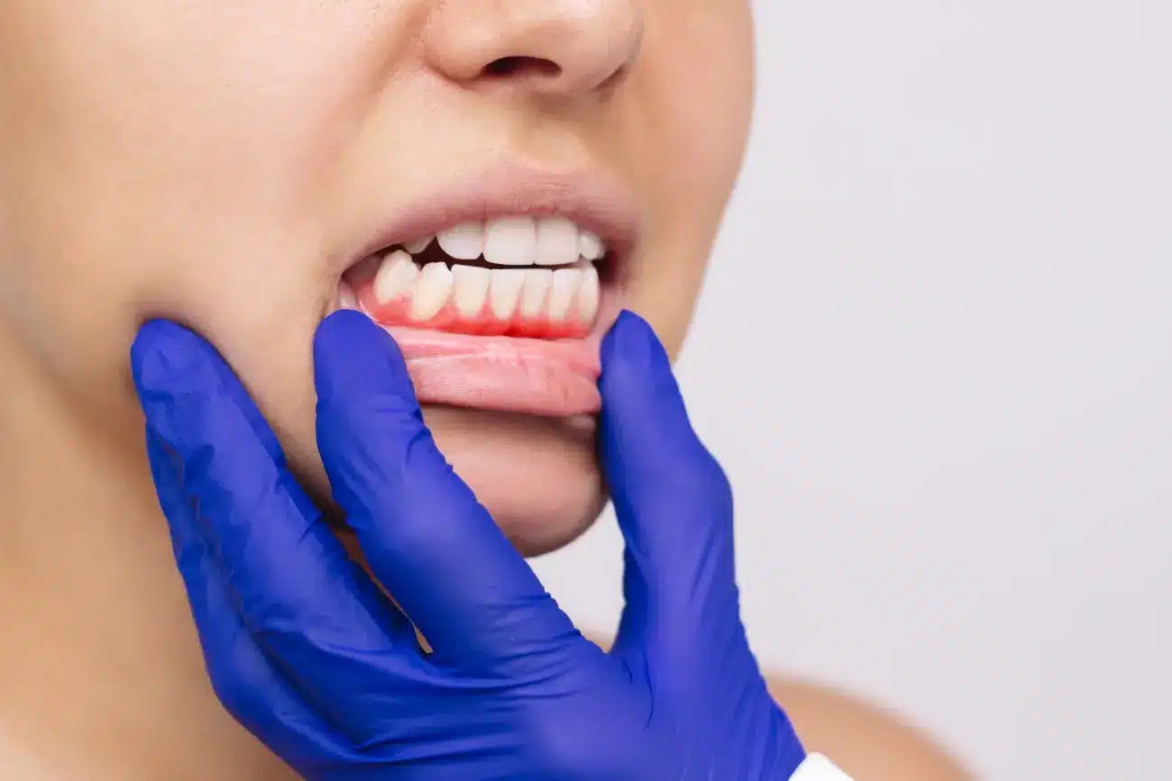 Parodontologija – liječenje desni i parodontalnih oboljenja